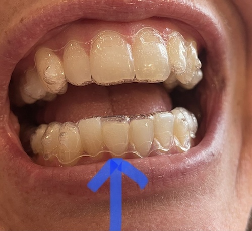 Tooth Adjustment
